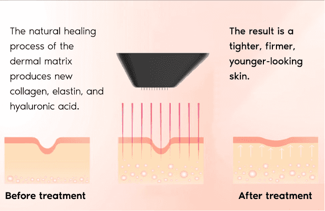 Skin Resurfacing