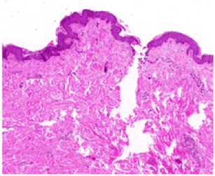 Deep and Narrow Ablation